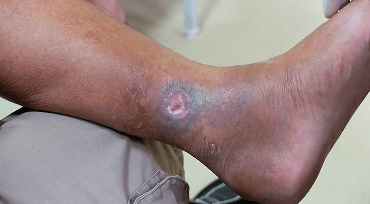 Tratamiento de úlceras venosas